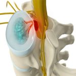 سندرم دم اسب چیست؟ علائم، زمان طلایی جراحی و خطرات 1 سندرم دم اسب