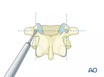 ایجاد کانال در لایه خارجی استخوان (Cortex)