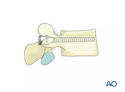 قرار دادن و پیچاندن (Insertion) پیچ