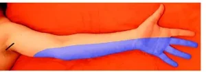 علل بی حسی در اندام ها