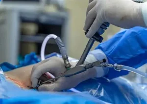 جراحی آندوسکوپی دیسک کمر